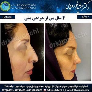 بهترین جراح بینی اصفهان 2