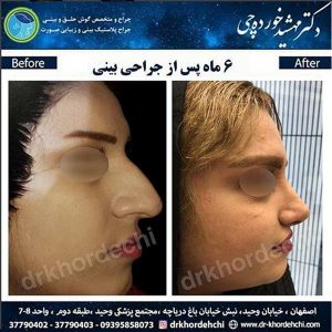 جراحی بینی اصفهان 3
