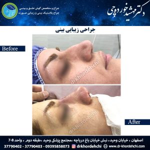 جراحی بینی اصفهان 40