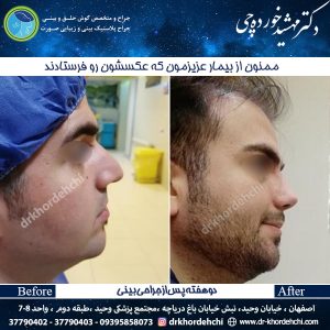 جراحی بینی اصفهان 50