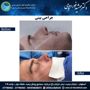 جراحی بینی اصفهان 53