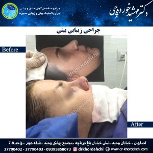 جراحی بینی اصفهان 58