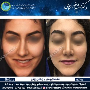 جراحی بینی اصفهان 60