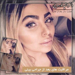 مراقبت های بعد از جراحی بینی - دکتر مهشید خورده چی در اصفهان