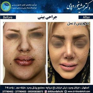 بهترین جراح بینی در اصفهان 3