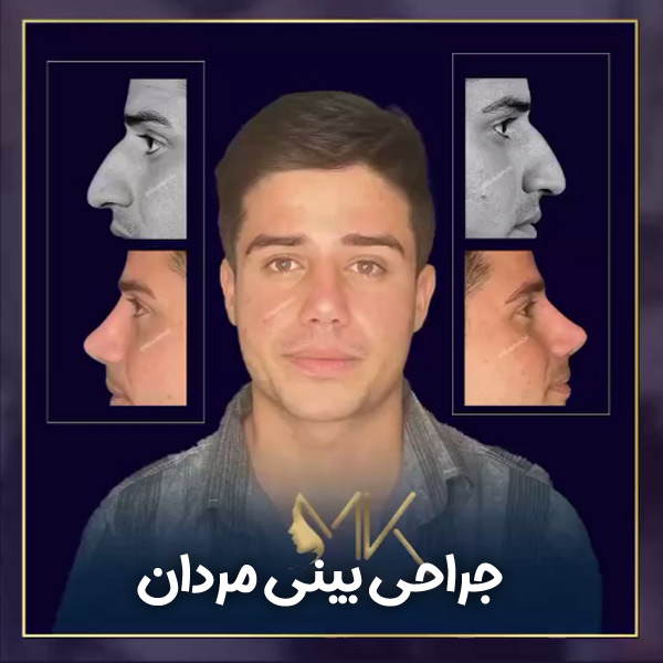 جراحی بینی مردان + دکتر مهشید خورده چی