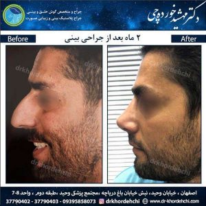 جراح بینی در اصفهان 2