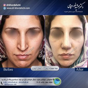 جراح بینی اصفهان - دکتر مهشید خورده چی