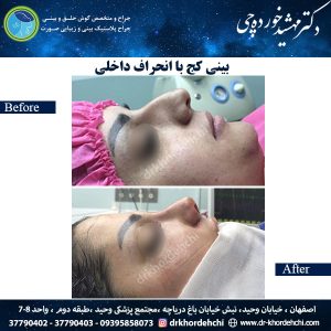 جراحی بینی اصفهان 54