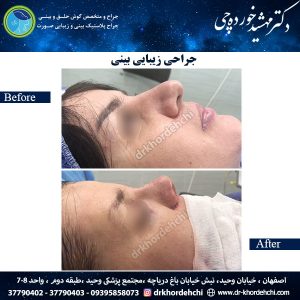جراحی بینی اصفهان 57