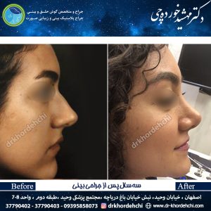 جراحی بینی اصفهان 61
