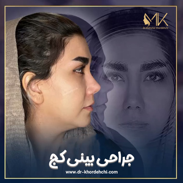 جراحی بینی کج - دکتر مهشید خورده چی
