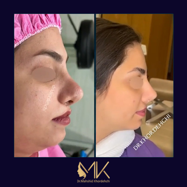 جراحی بینی ترمیمی در اصفهان _ دکتر مهشید خورده چی