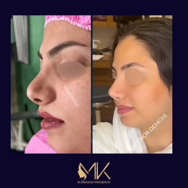 جراحی بینی ترمیمی در اصفهان - دکتر مهشید خورده چی
