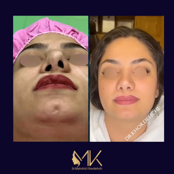 جراحی بینی ترمیمی در اصفهان - دکتر مهشید خورده چی