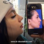 جراحی بینی فانتزی - دکتر مهشید خورده چی در اصفهان