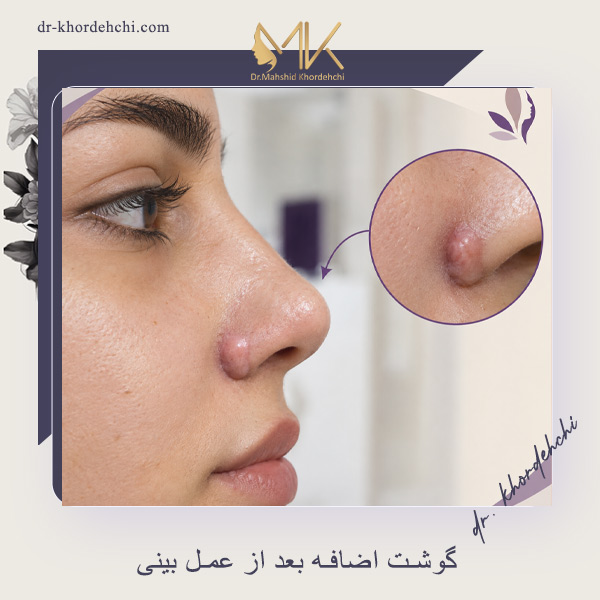 گوشت اضافه بعد از عمل بینی - دکتر خورده چی
