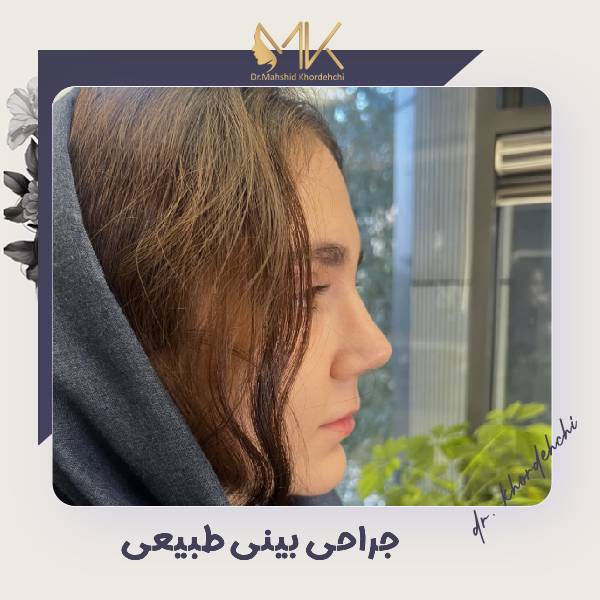 عکس جراحی بینی طبیعی