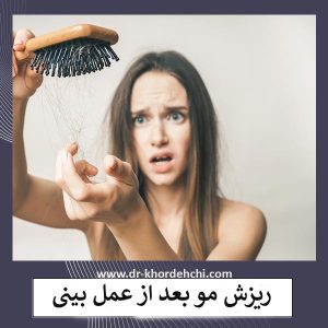 ریزش مو بعد از جراحی بینی _ دکتر مهشید خورده چی