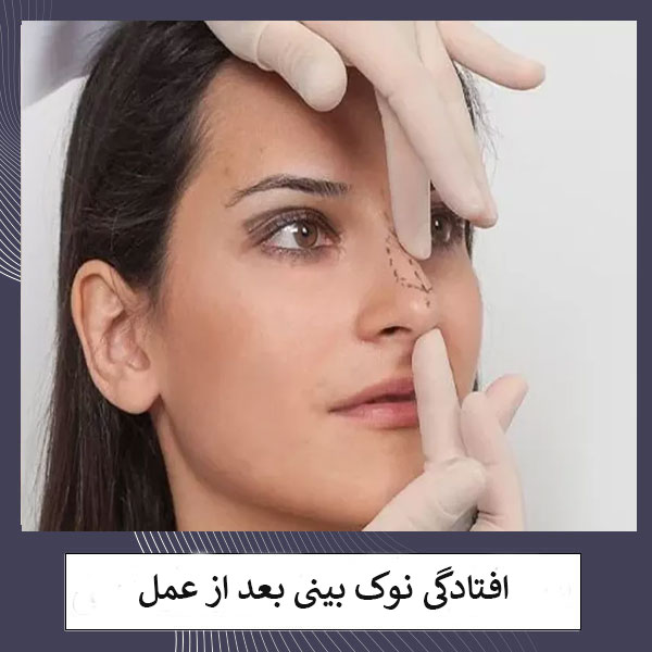 افتادگی نوک بینی بعد از عمل _ دکتر مهشید خورده چی