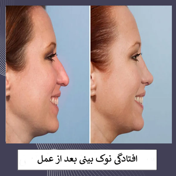 افتادگی نوک بینی بعد از جراحی _ دکتر مهشید خورده چی