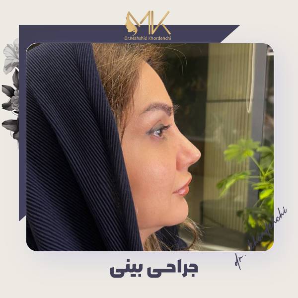 عکس رینوپلاستی