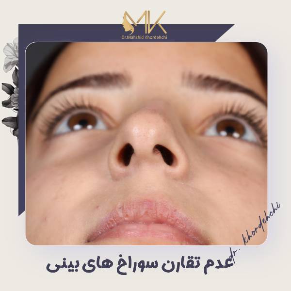 نامتقارنی سوراخ های بینی بعد از جراحی