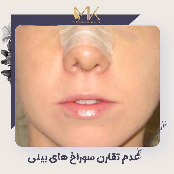 نامتقارنی سوراخ های بینی بعد از عمل