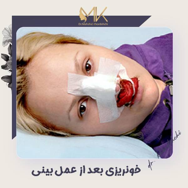 خونریزی بینی بعد از جراحی