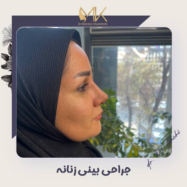 جراحی بینی زنان