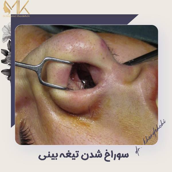 سوراخ شدن تیغه بینی