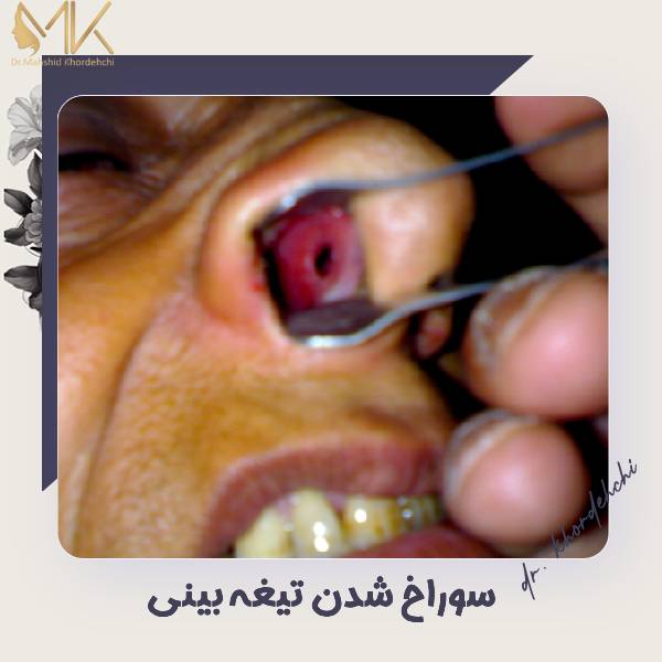 آسیب تیغه بینی