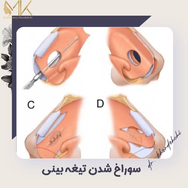 سوراخ تیغه بینی