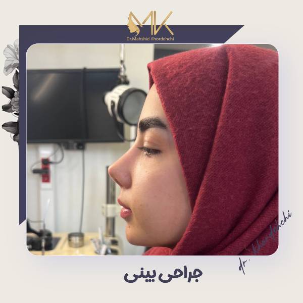 عکس نمونه عمل بینی در اصفهان