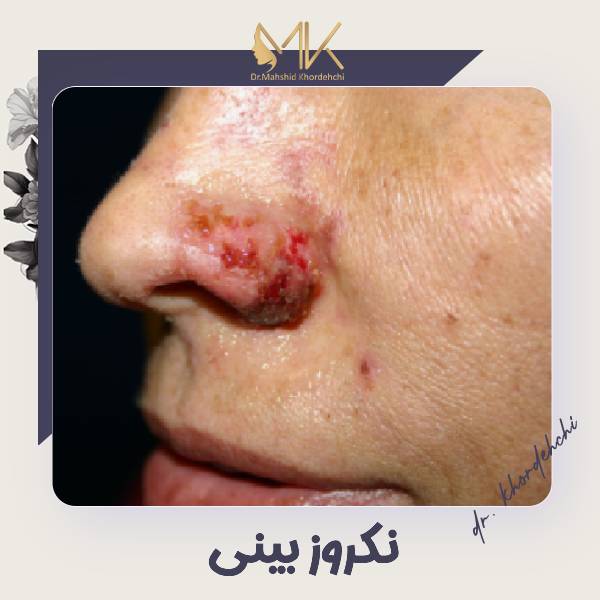 عکس نکروز بینی