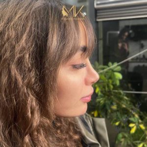 جراحی زیبایی بینی دکتر خورده چی