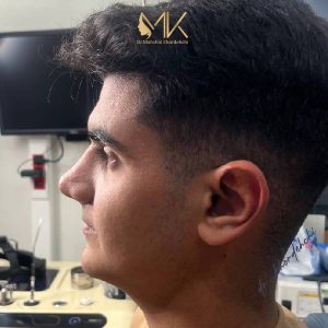 عمل زیبایی بینی دکتر خورده چی