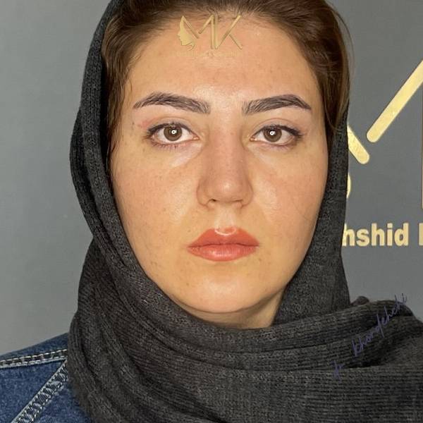 جراحی زیبایی بینی دکتر خورده چی