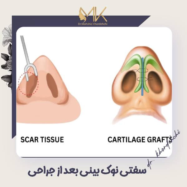 سفتی نوک بینی بعد از جراحی