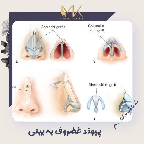 جراحی پیوند غضروف به بینی