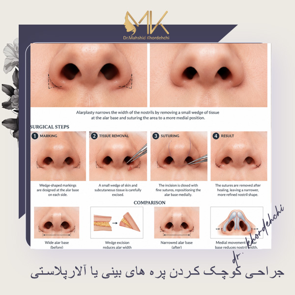 آلارپلاستی یا جراحی کوچک کردن پره های بینی