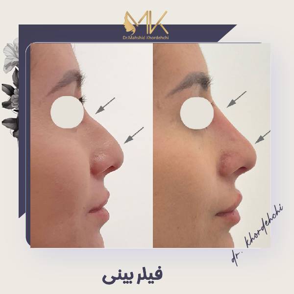 تزریق فیلر بینی