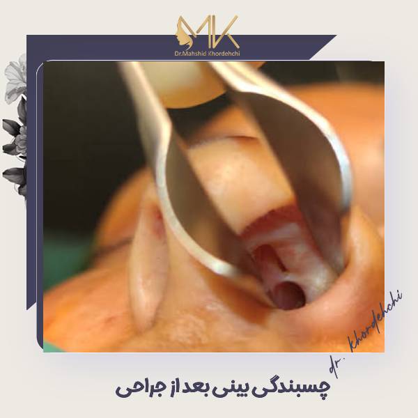 چسبندگی بینی بعد از جراحی