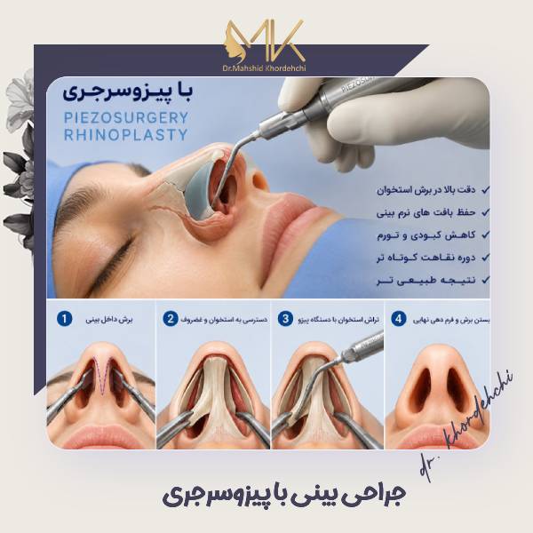جراحی بینی یا عمل بینی با پیزوسرجری در اصفهان