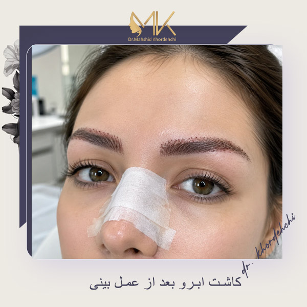 کاشت ابرو بعد از عمل بینی - دکتر مهشید خورده چی