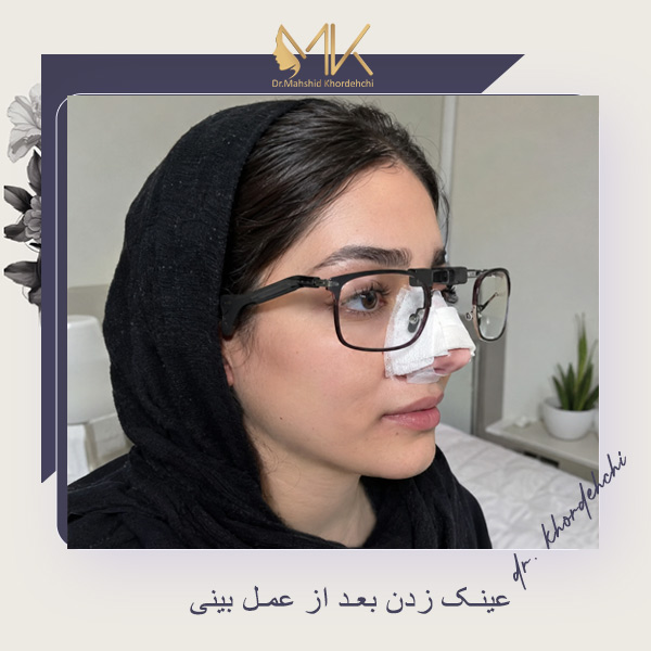 عینک زدن بعد از عمل بینی - دکتر خورده چی