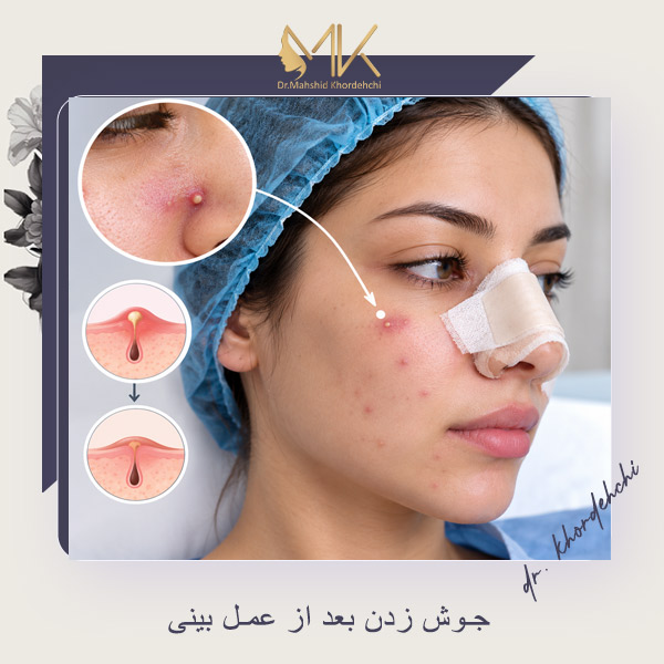 جوش زدن بعد از عمل بینی - دکتر خورده چی